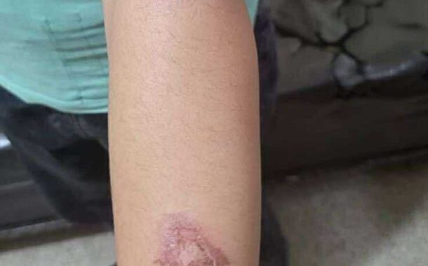 جريمة مروّعة في البقاع: أم تعنّف أطفال زوجها وتحرق ابنته بسكين… بتواطؤ من الزوج!